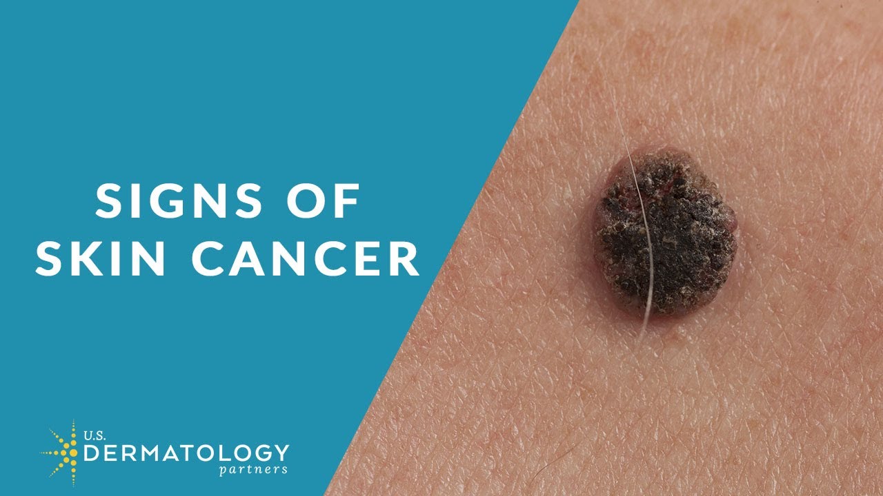 Dasion - Skin Cancer Injury